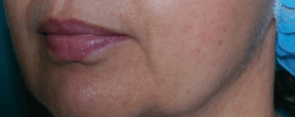 Profile Harmonization — before