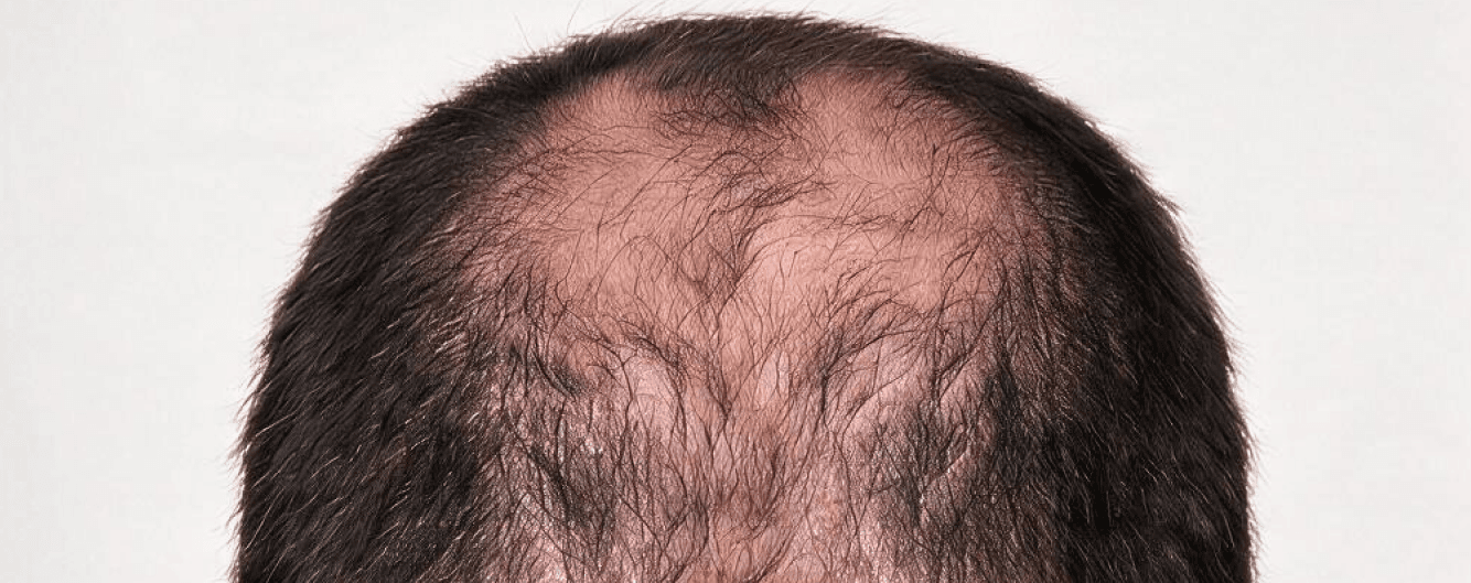 Hair Density Improvement — before