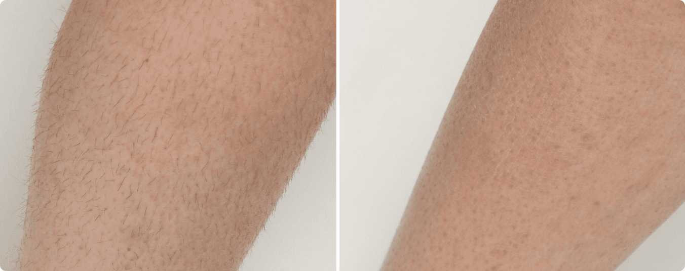 Permanent Hair Reduction — before