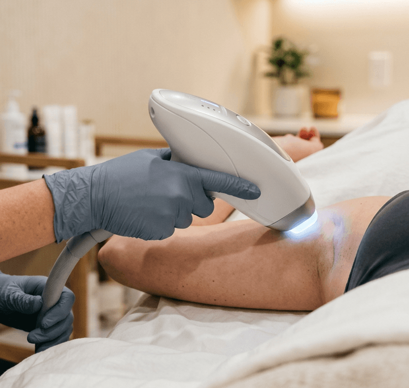 A clinician performing laser hair removal on a patient's underarm with a handheld device