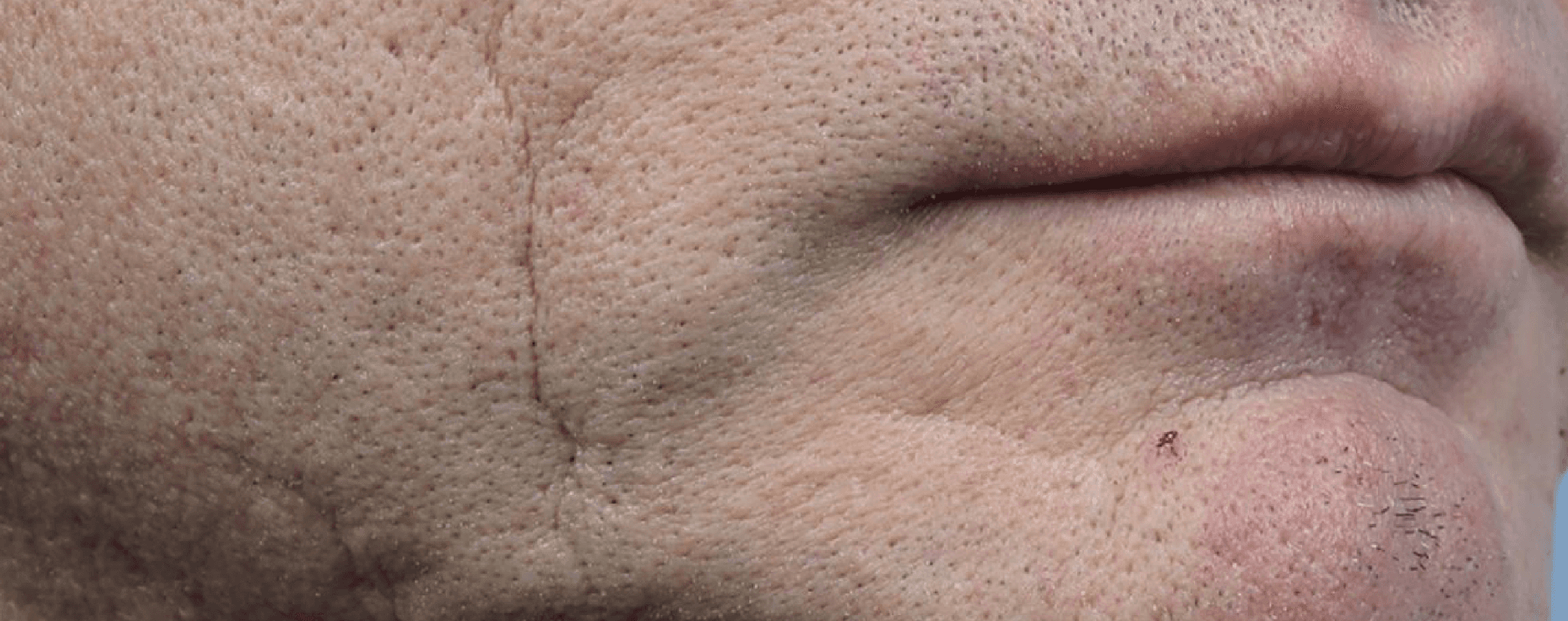 Scar & Skin Texture Improvement — before