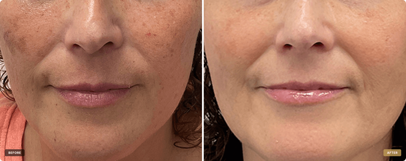 Facial Pigmentation Reduction — before