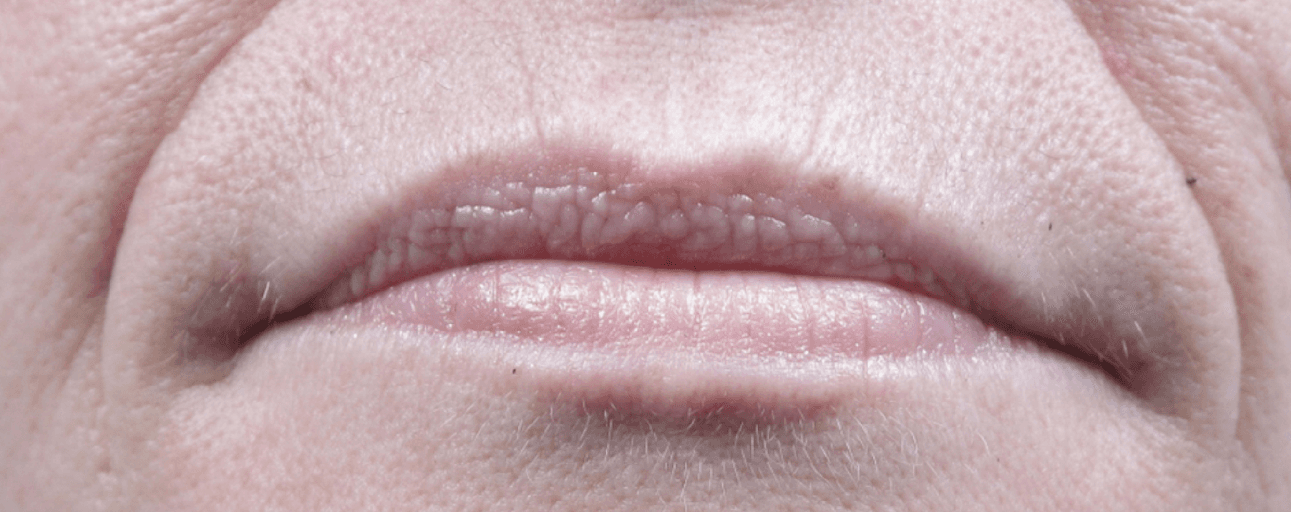 Lip & Perioral Line Smoothing — before