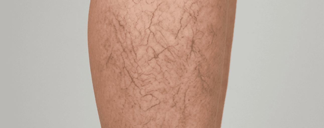 Spider Vein Treatment — before